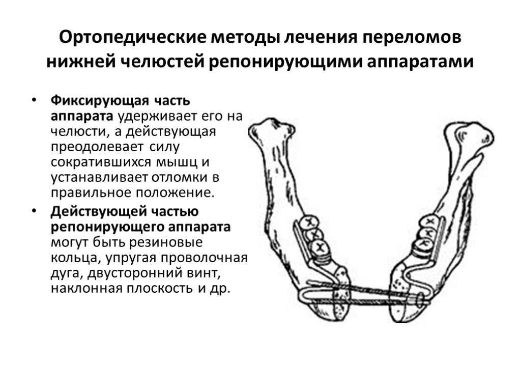 Фиксирующие аппараты предназначены для. классификация ортопедических аппаратов для лечения челюстно-лицевых травм