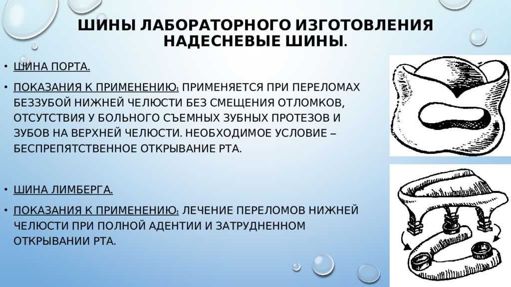 Технология изготовления шины вебера. тема: изготовление шин и шин-протезов. демонстрация изготовления шин (ванкевич, тигерштедта). цель занятия. методы межчелюстного лигатурного скрепления