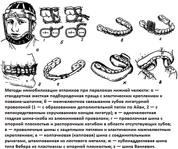 Транспортные шины при переломах челюстей