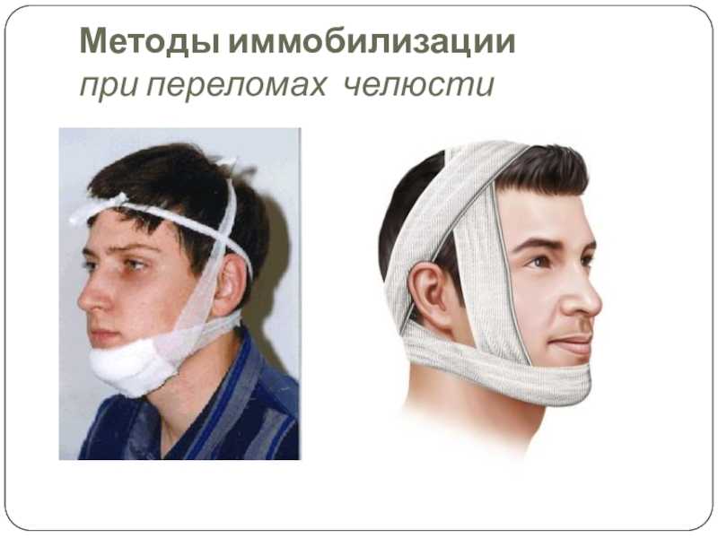 Оказание помощи при переломах верхней и нижней челюстей, методы временной иммобилизации