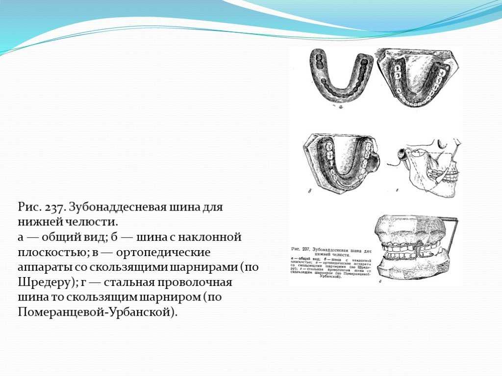 Классификация аппаратов применяемых для лечения переломов. общая характеристика челюстно-лицевых аппаратов и их классификация