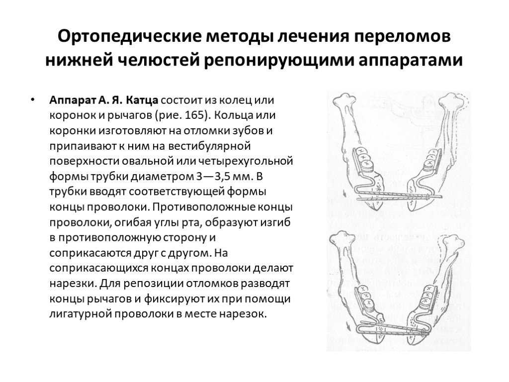 Консервативные методы иммобилизации отломков челюстей - хирургическая стоматология от а до я