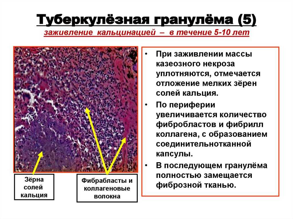 Грануляция раны - что это такое и какие виды грануляций существуют