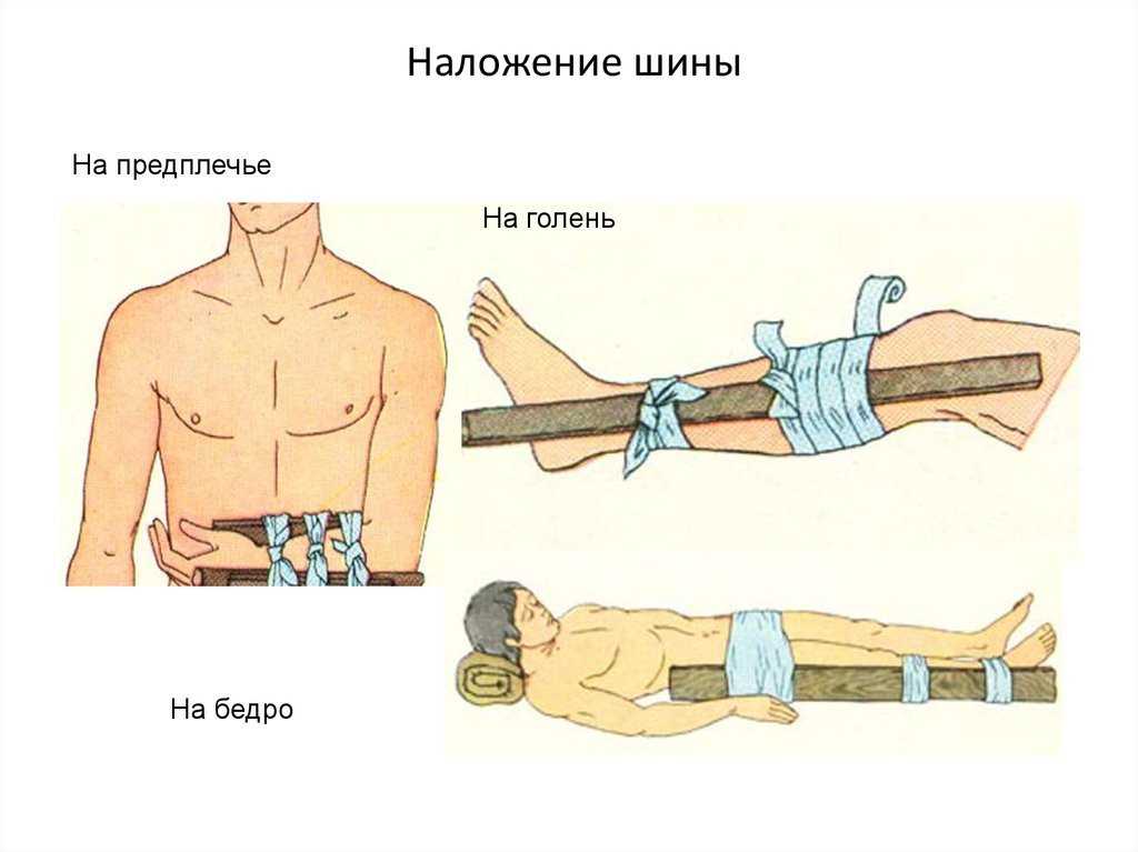 Основы транспортной иммобилизации | медицинская энциклопедия