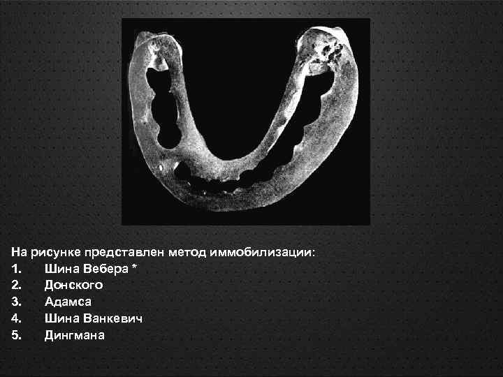 Способ изготовления эластичной межчелюстной шины для иммобилизации отломков при переломах челюстей российский патент 2021 года по мпк a61c8/00 