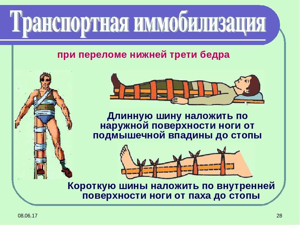Из чего можно сделать шину при переломе