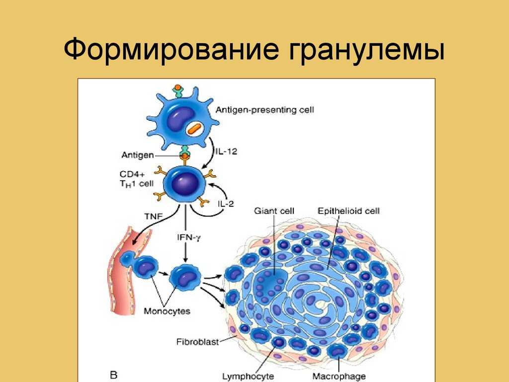 Абсцесс