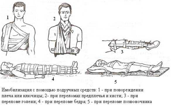 Транспортная иммобилизация при переломах