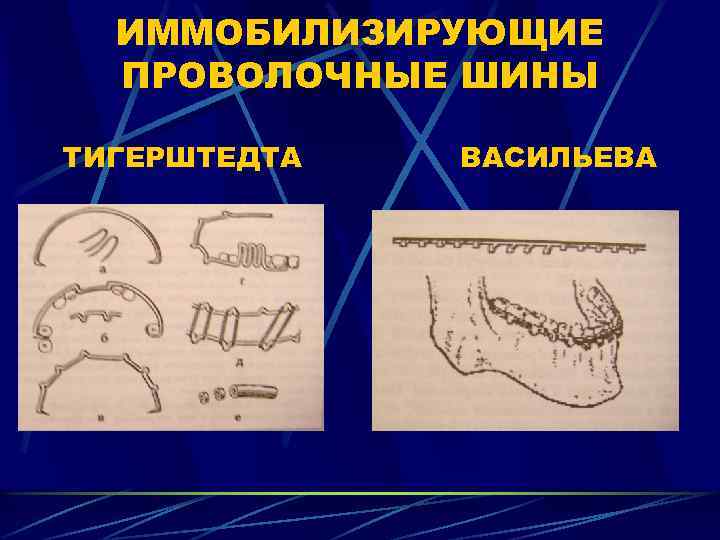 Постановка зубов по васильеву