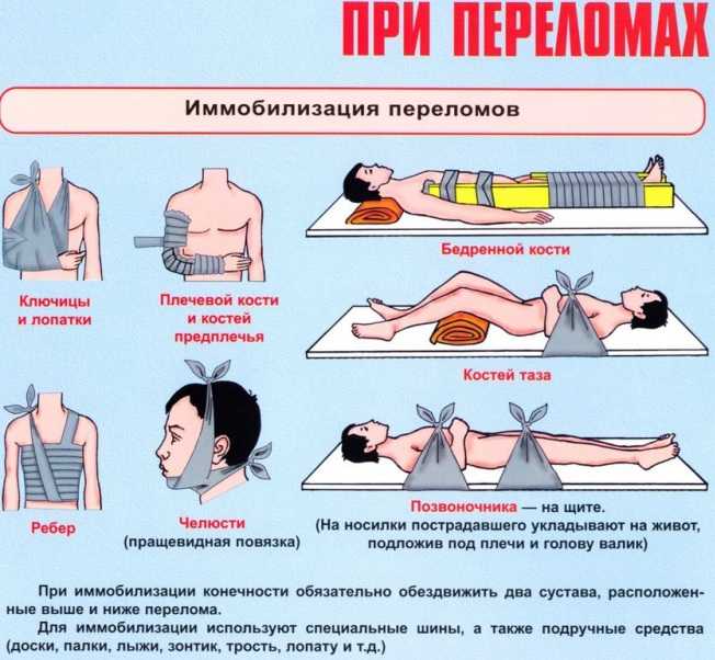 Переломы костей: виды, классификация (какие бывают), осложнения
