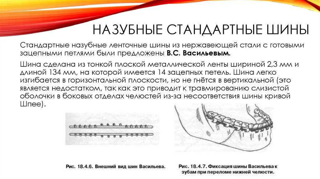 Консервативные методы иммобилизации отломков челюстей - хирургическая стоматология от а до я